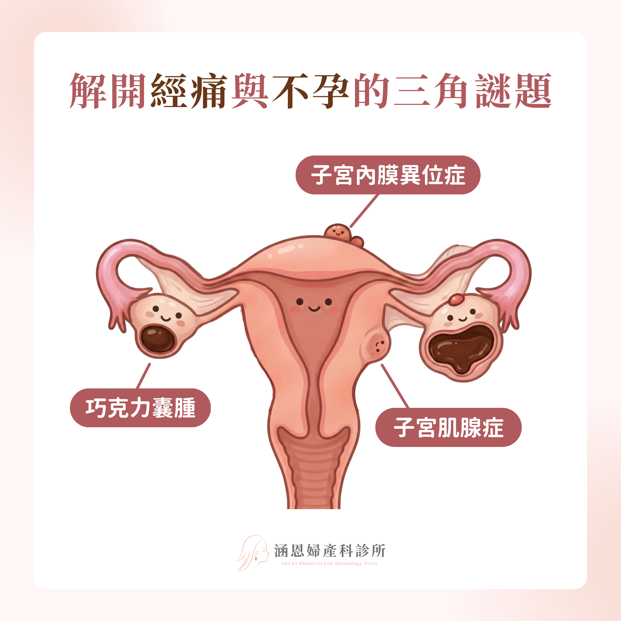 子宮肌腺症、子宮內膜異位症與巧克力囊腫的病灶位置差異：肌腺症在子宮肌層、內膜異位症在子宮以外、巧克力囊腫在卵巢
