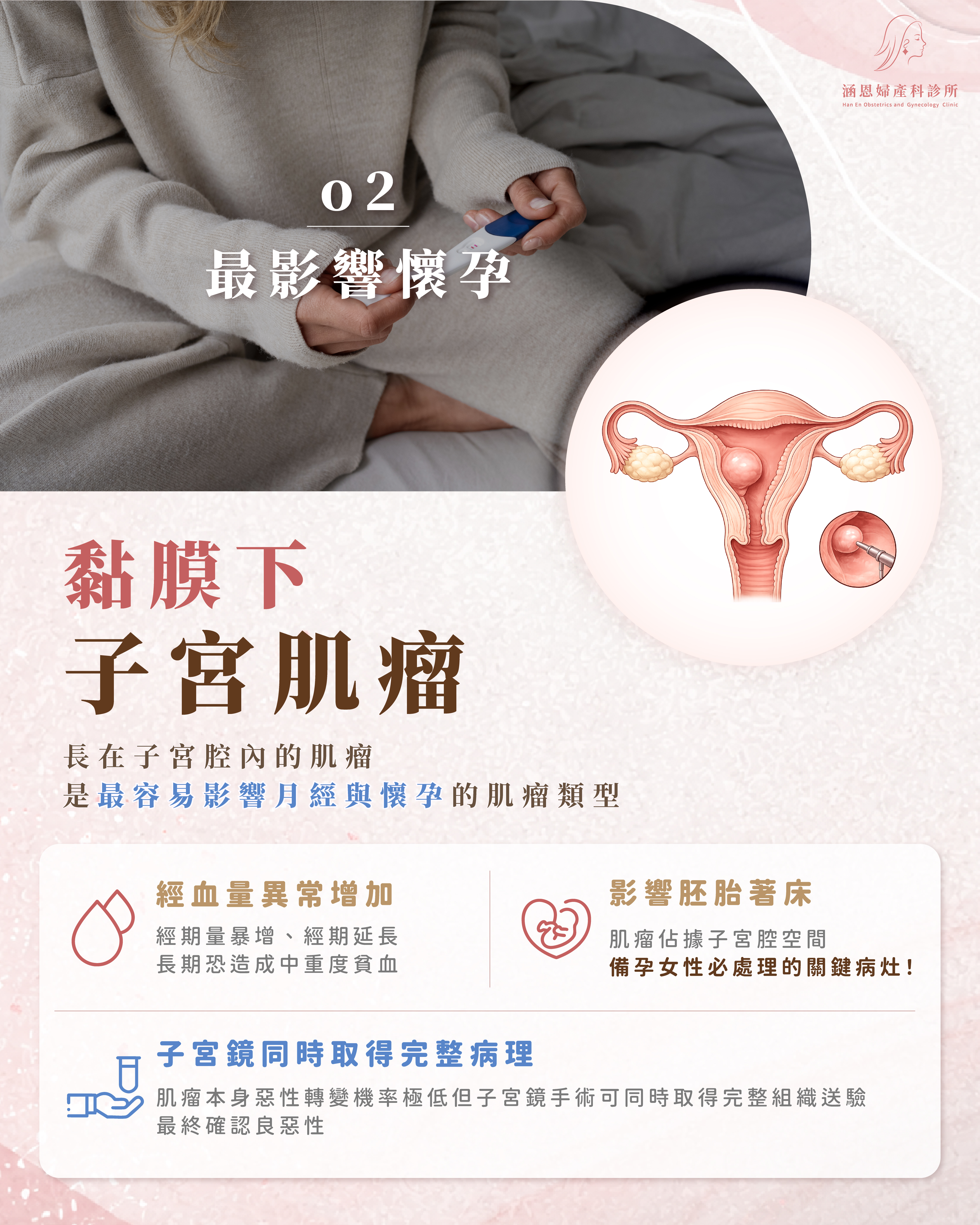 黏膜下子宮肌瘤示意圖：肌瘤往子宮腔內側生長，阻塞著床空間、造成經血爆量