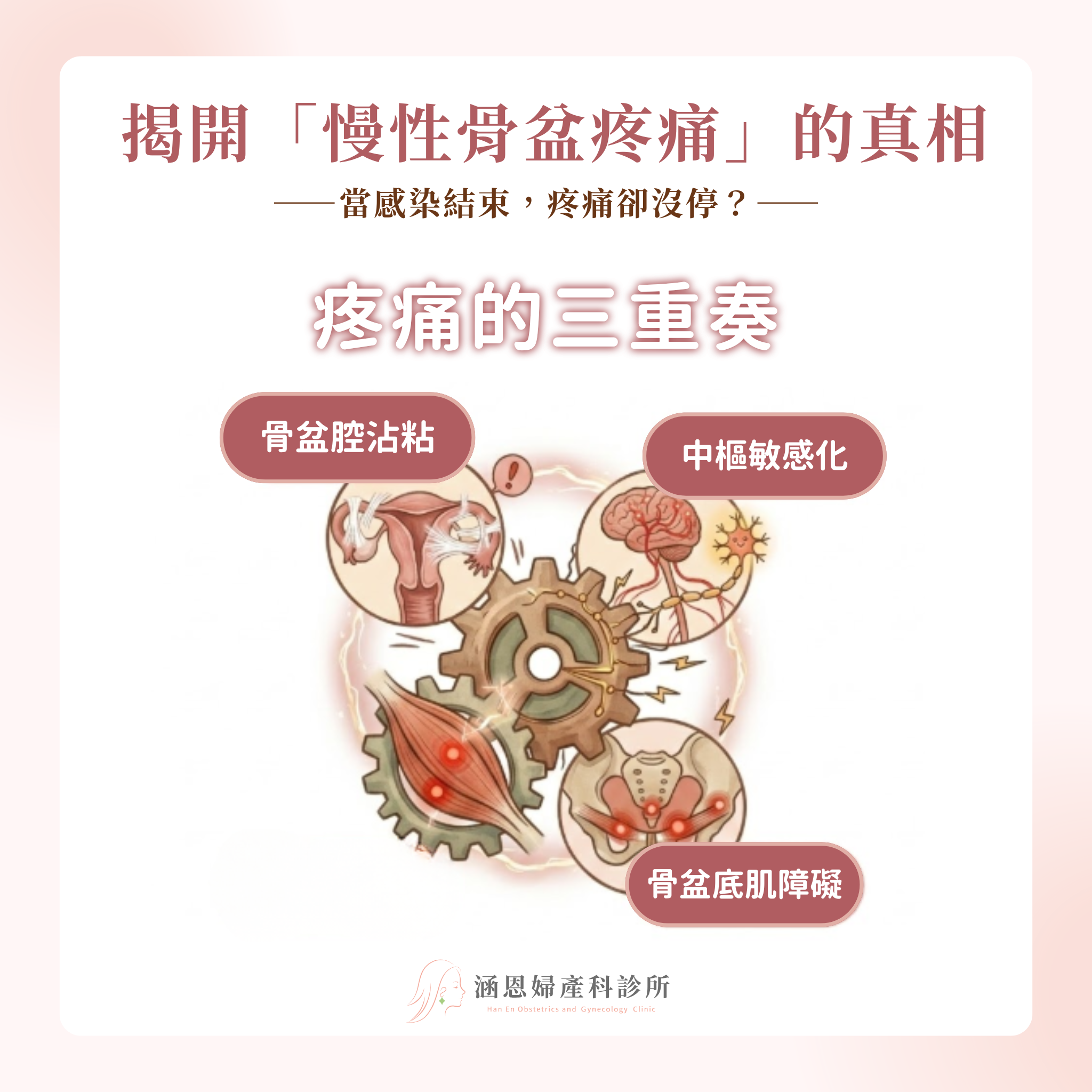 慢性骨盆疼痛CPP骨盆腔沾黏中樞敏感化與骨盆底肌功能障礙治療新竹婦產科