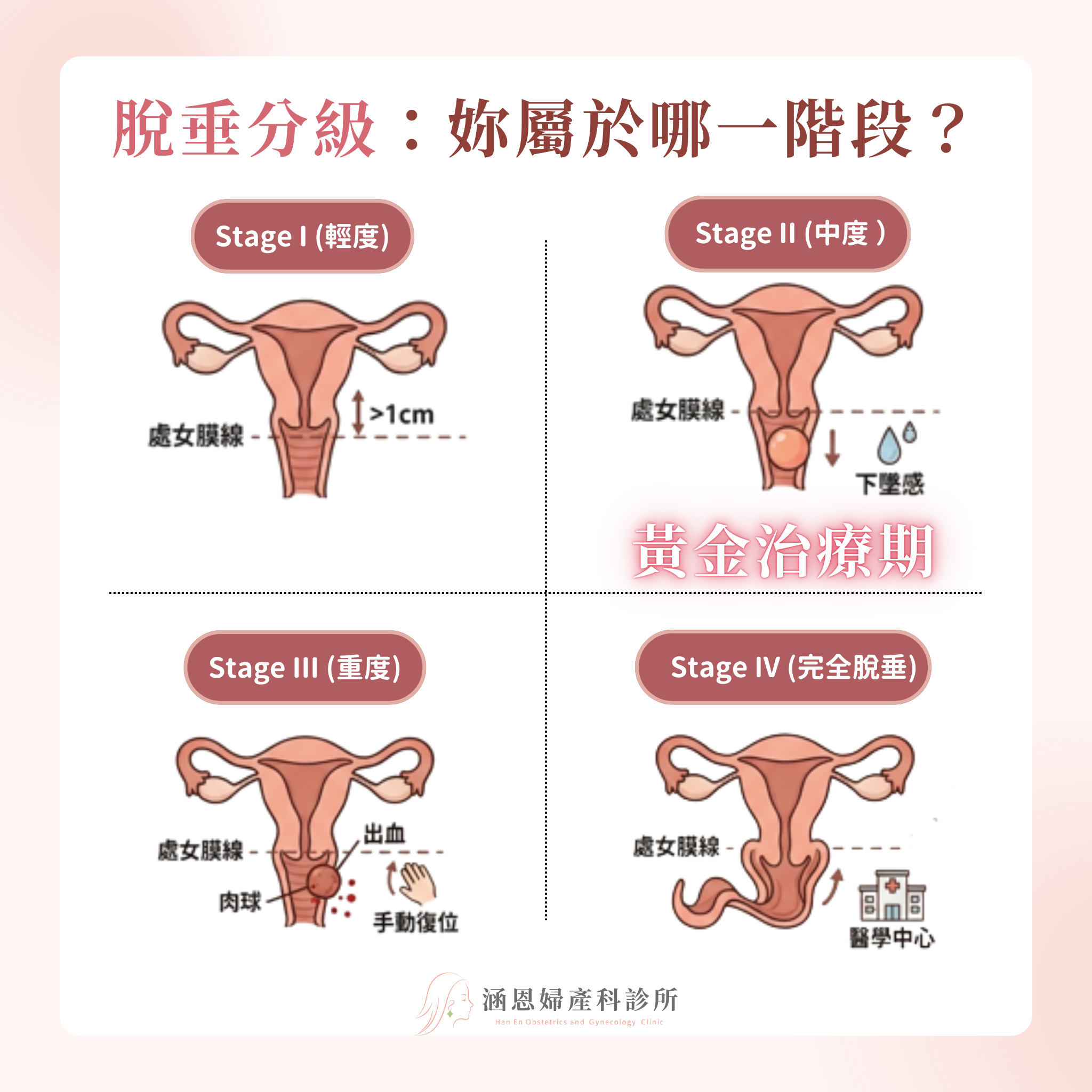 POPQ骨盆器官脫垂分級系統與脫垂程度量化台中竹北婦產科精準診斷