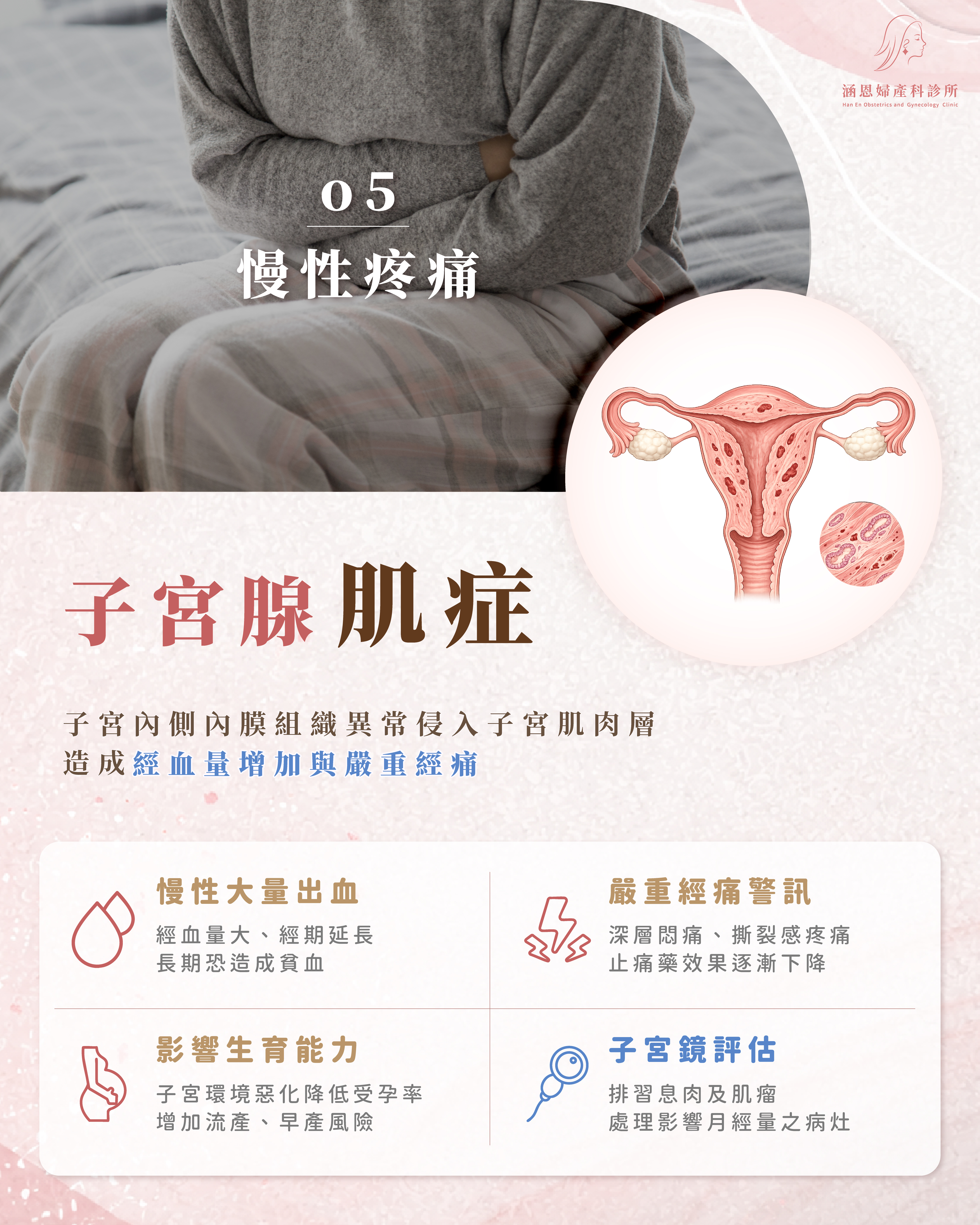 子宮腺肌症示意圖：內膜組織長進子宮肌肉層造成慢性失血與劇烈經痛